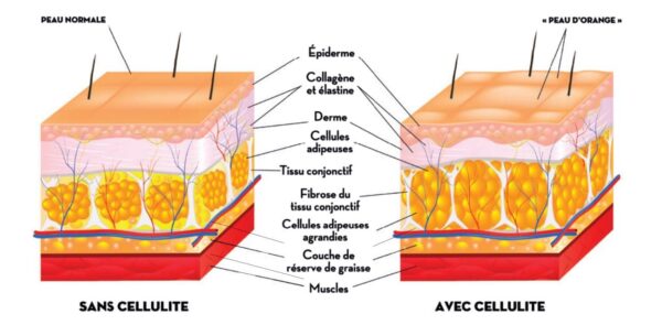 comparatif cellulite